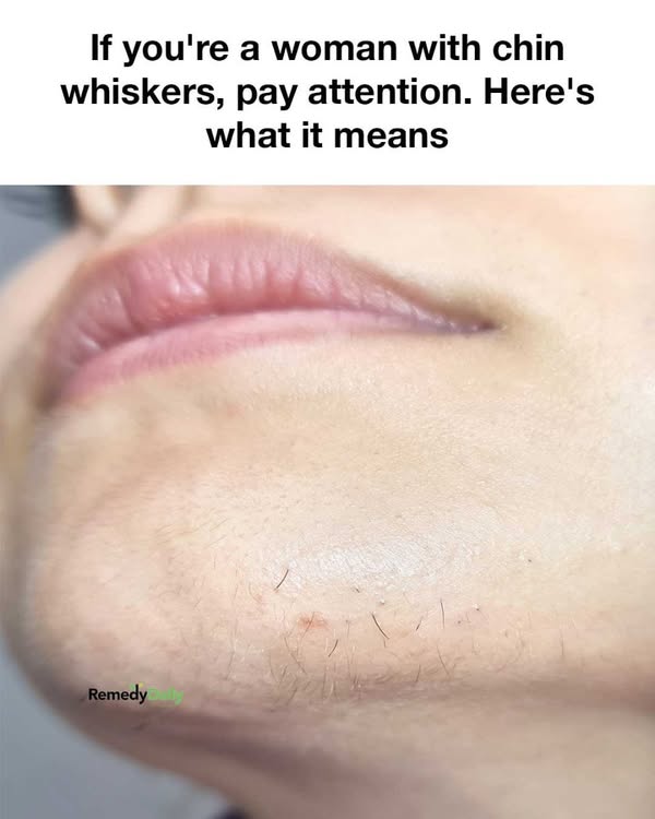 Chin Whiskers