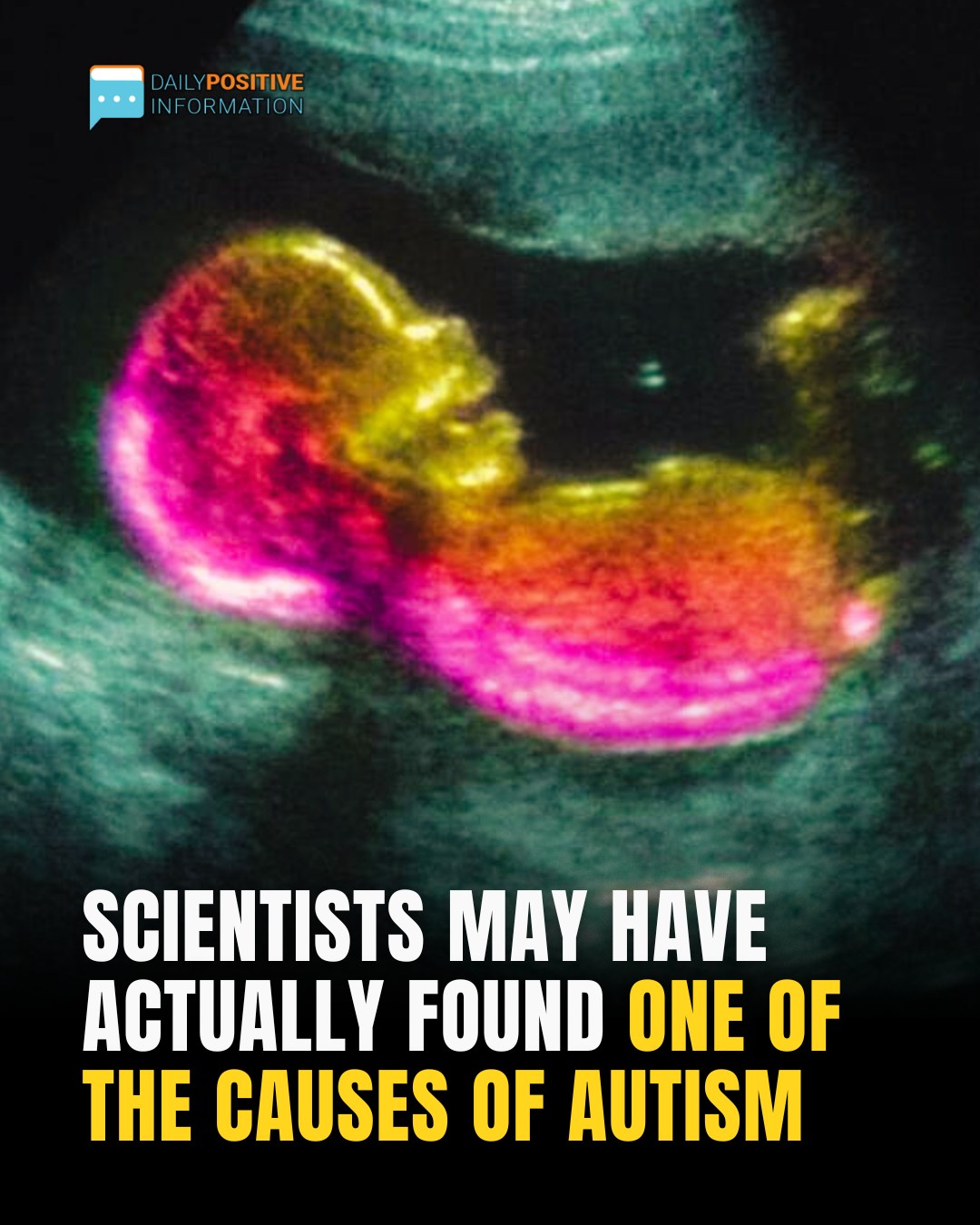 Study Suggests Key Link That Could Help Explain Autism DevelopmentStudy Suggests Key Link That Could Help Explain Autism Development