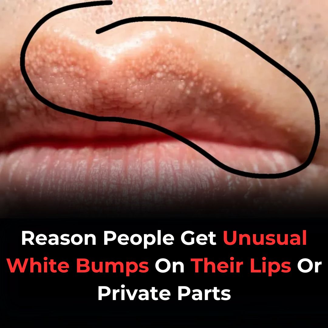 Why You Might See Unusual White Bumps On Your Lips Or Genitals