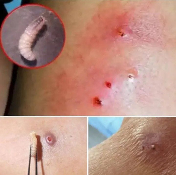 HT14. Larvae Found in Young Woman’s Body… How Did They Get There? (The Answer Will Horrify You)