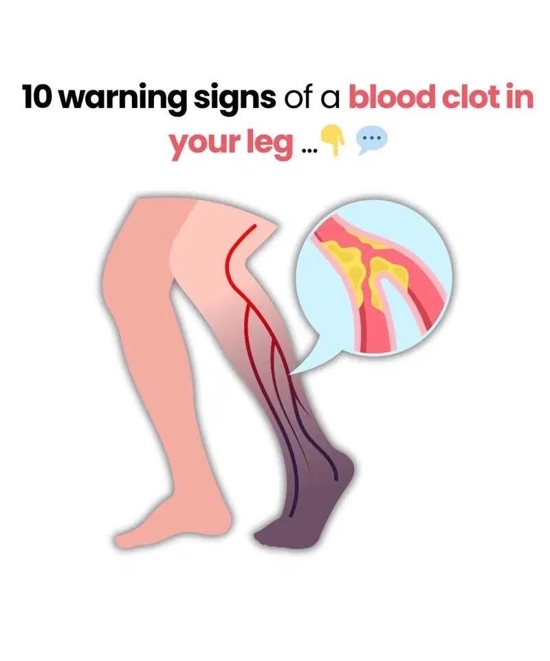 Top 10 signs of a BLOOD CLOT in your leg (prevent Deep Vein Thrombosis)
