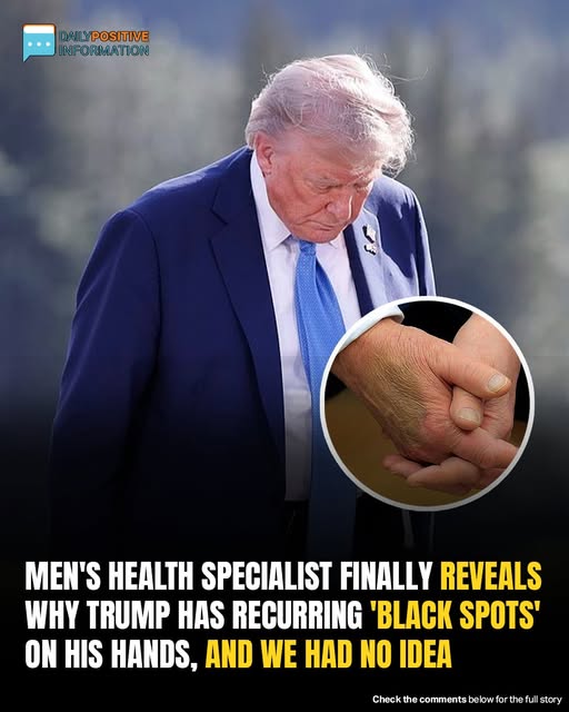 Men’s Health Specialist Finally Reveals Why Trump Has Recurring ‘Black Spots’ On His Hands, And We Had No Idea