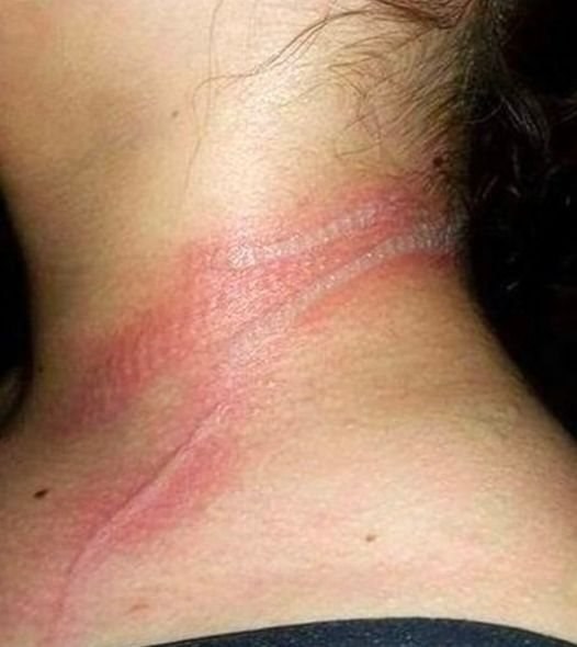 13-year-old girl left with horrific burns on her neck after using her cellphone while it was charging