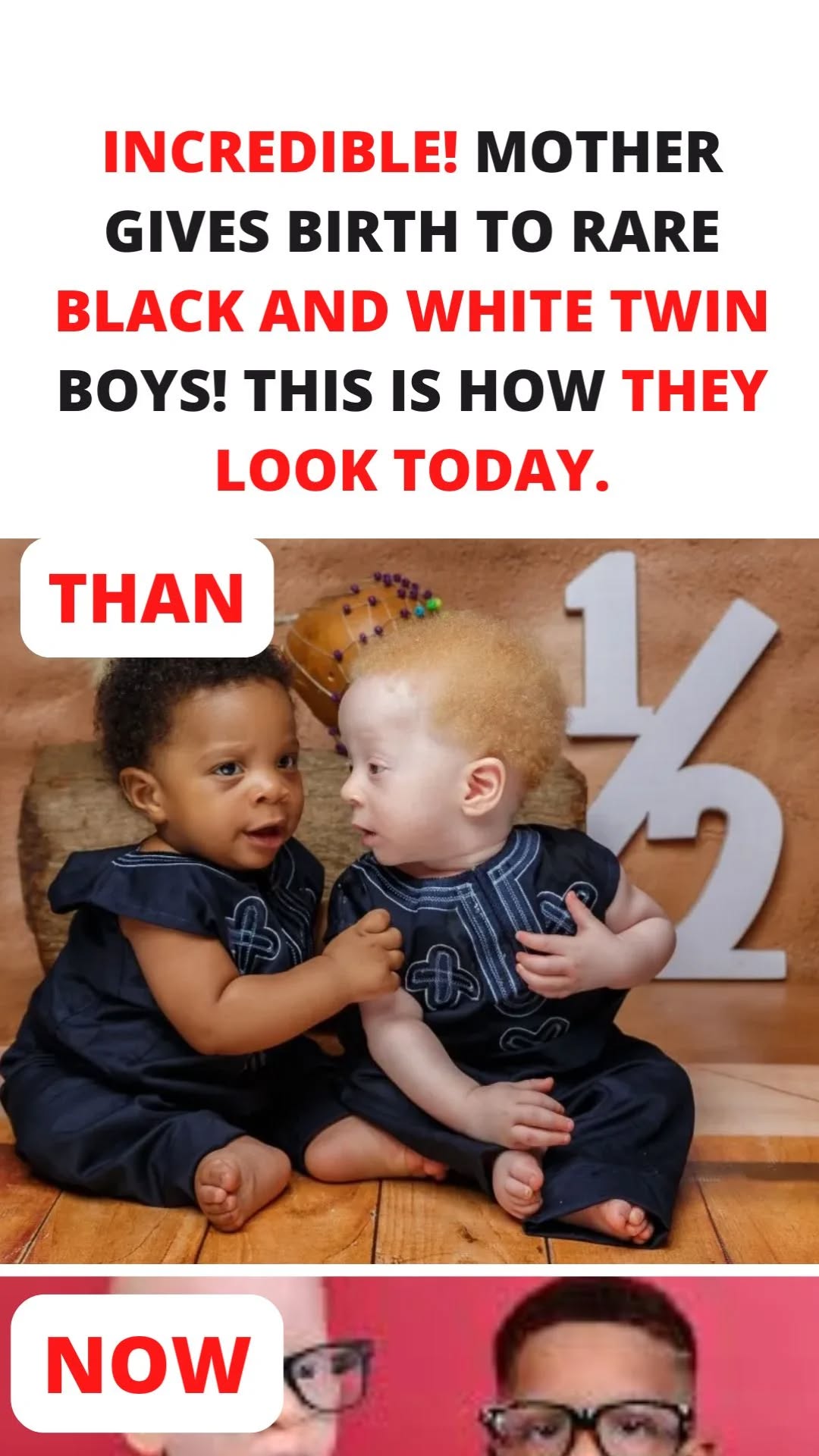 ST, Rare Miracle: Mother Gives Birth to Black and White Twin Boys!