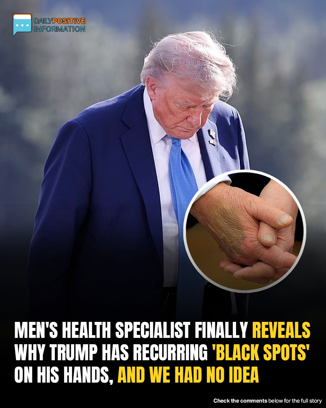 Men’s Health Specialist Finally Reveals Why Trump Has Recurring ‘Black Spots’ On His Hands, And We Had No Idea