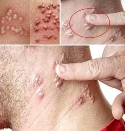 Viral Finger Bumps Story Raises Eyebrows — But What’s the Real Cause?