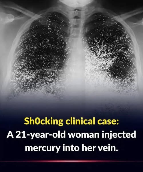 Sh0cking clinical case: 21-year-old woman injected mercury into a vein.