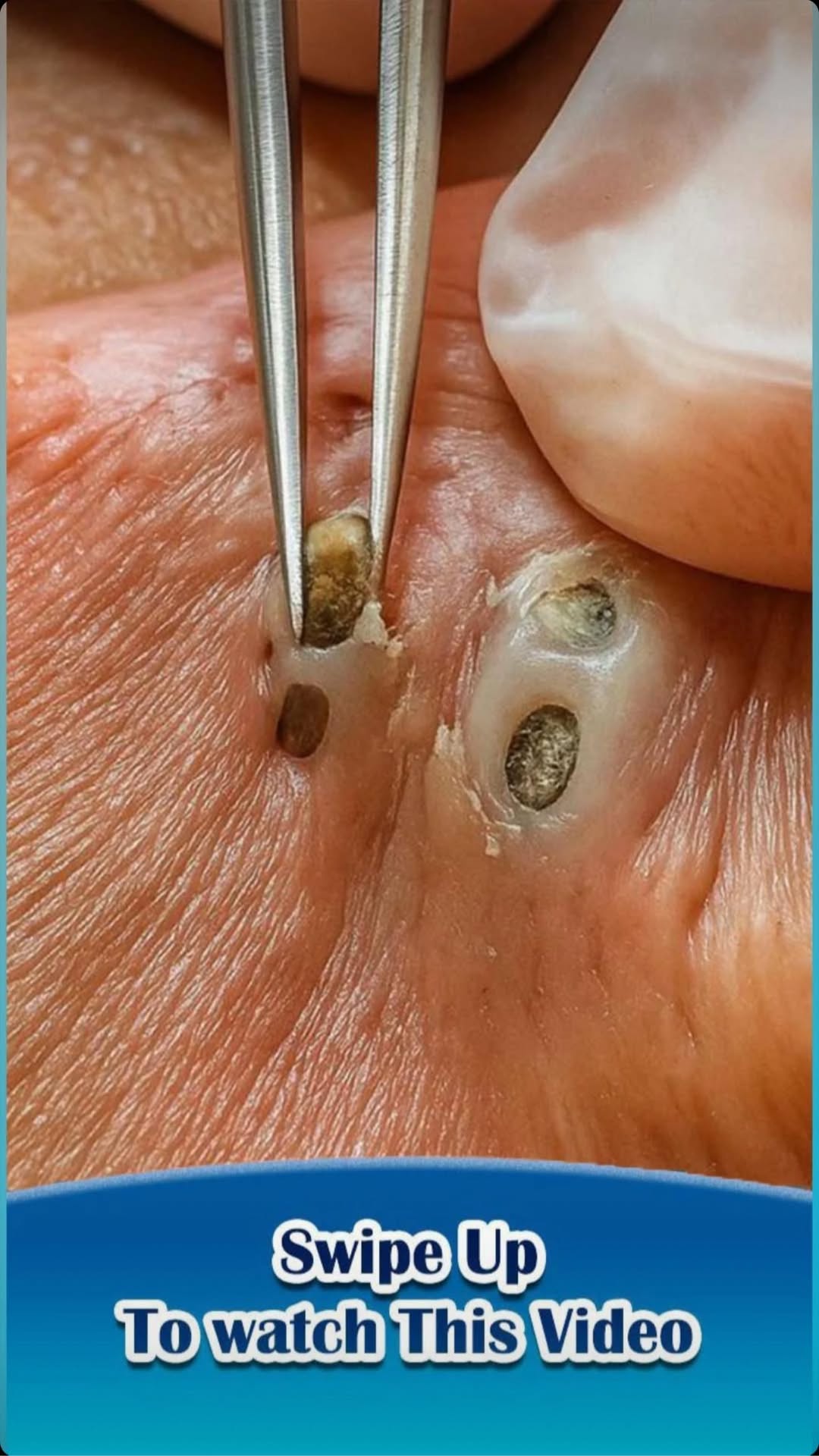 6 Types of Acne and What Might Cause Them