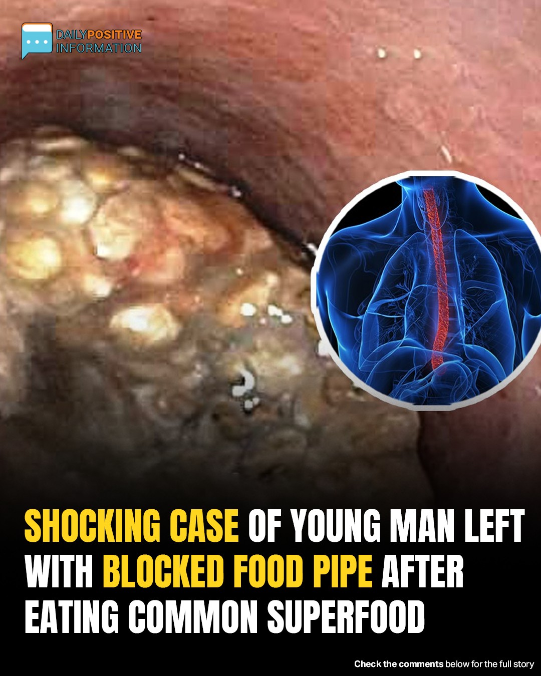 Routine Smoothie Ingredient Causes Severe Food Pipe Obstruction In Health-Conscious Teen