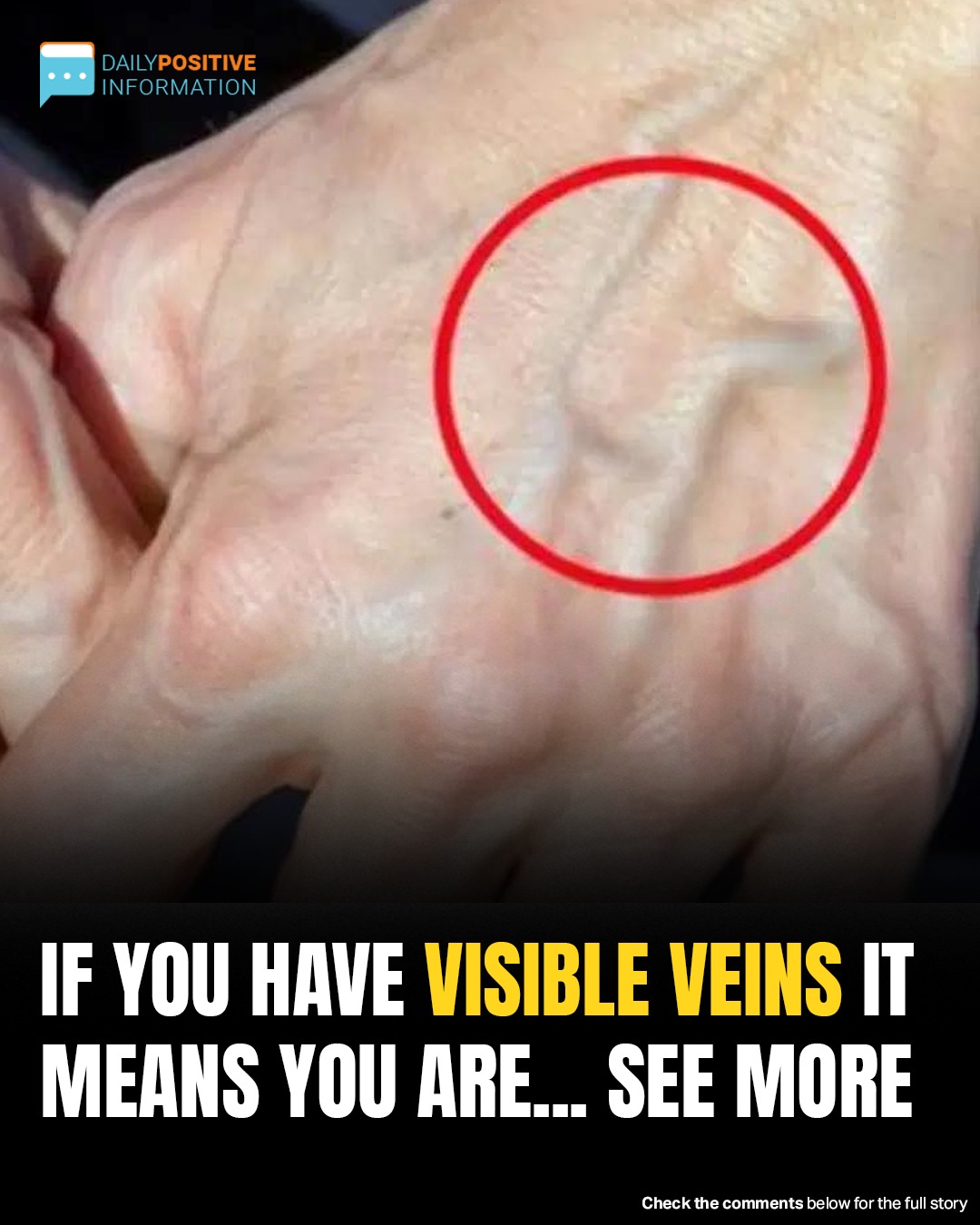 Sudden Vein Appearance: When It’s Normal—And When It’s Not