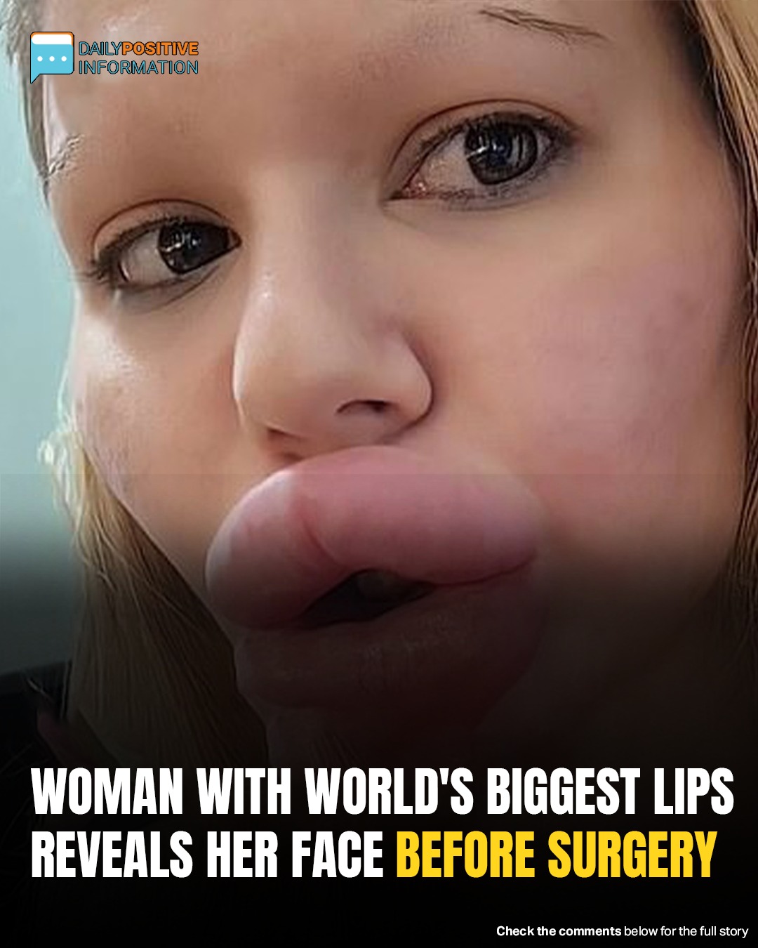 Before And After: Woman With Extreme Lip Enhancements Reveals Old Look