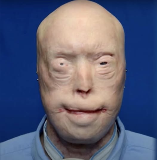 Firefighter suffers third-degree burns – this is him 7 years later