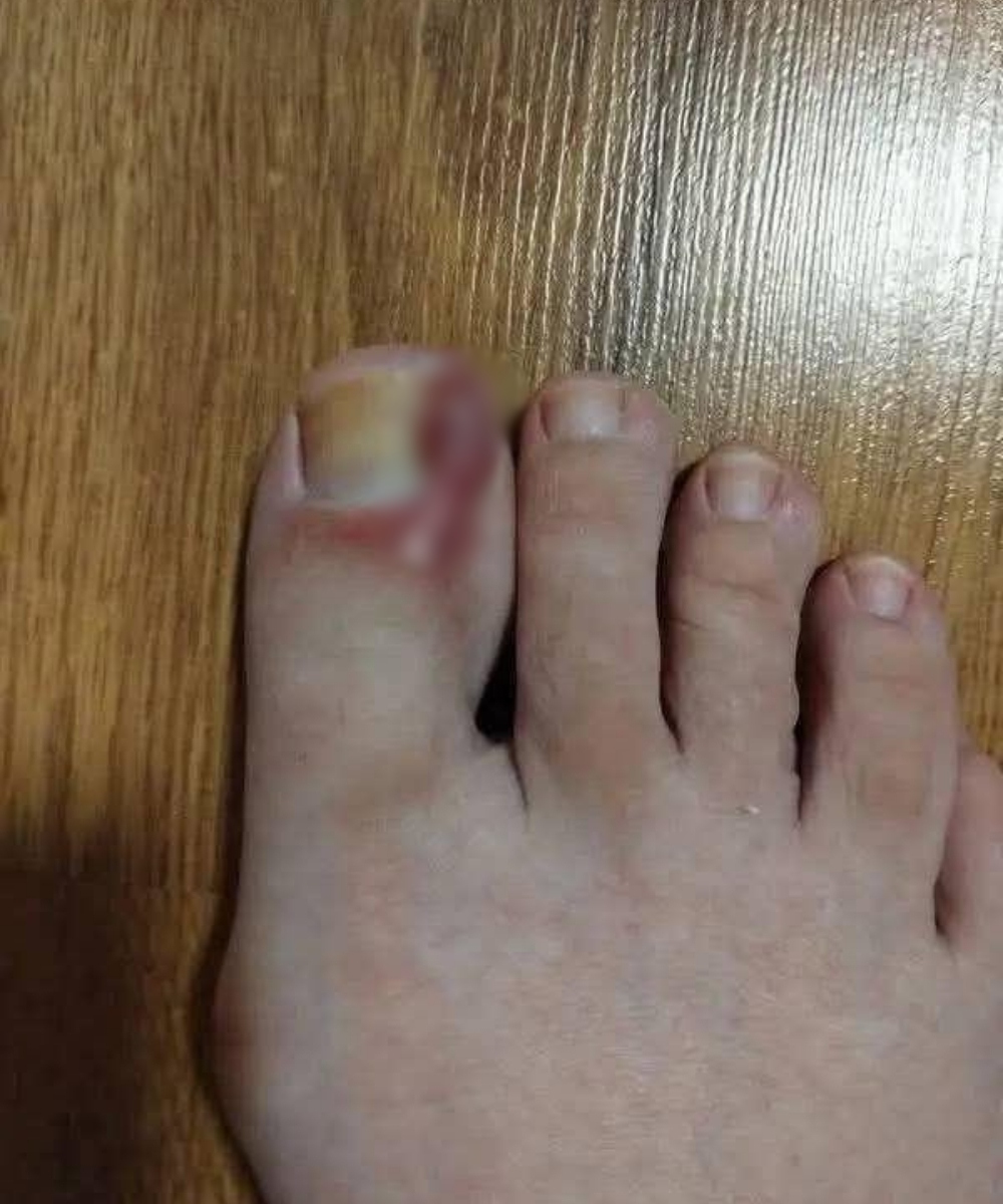 How to Treat an Ingrown Toenail at Home: Tips and Natural Remedies