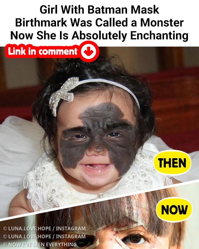 Girl With Batman Mask Birthmark Was Called a Monster Now She Is Absolutely Enchanting