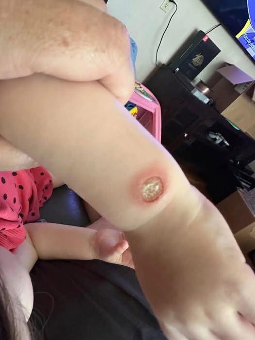 Unusual Case of Sweet Syndrome Triggered by New Inhaler Therapy in Primary Care