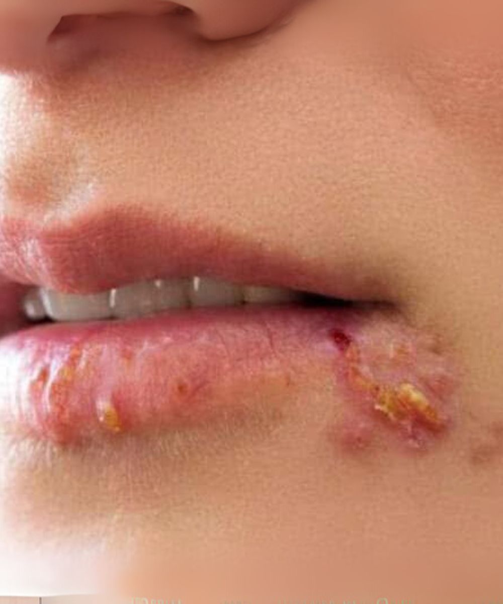 If you see this appearing on your lips, it is a sign of ca….