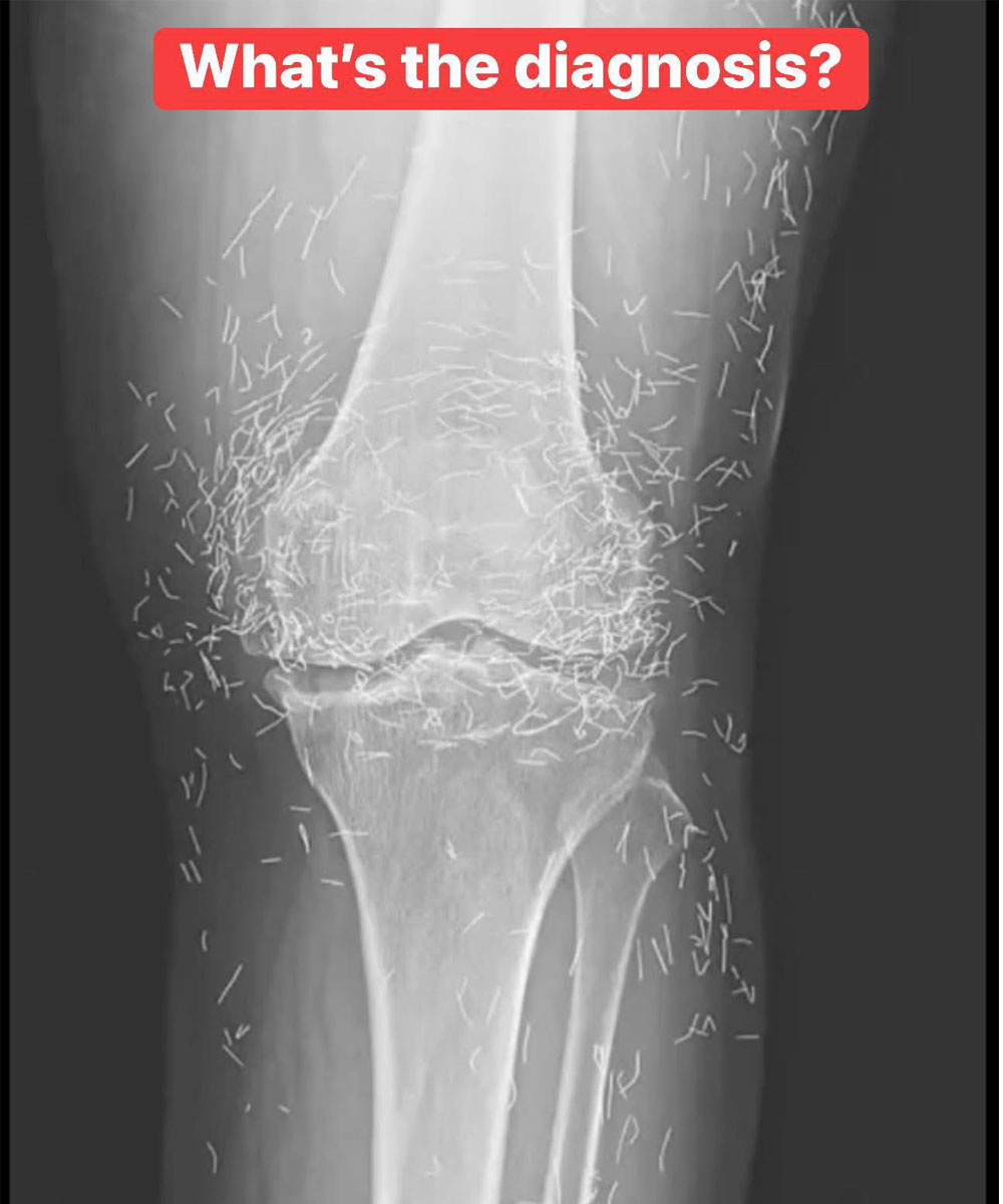 X-Ray Reveals Hundreds of Gold Needles in Woman’s Knees