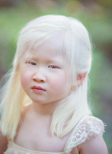 A baby girl born with albinism was abandoned by her parents, She looked too weird for them and left her at an orphanage door