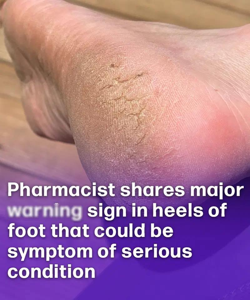 Pharmacist reveals wa.rning sign in heels of foot that could be symptom of serious condition