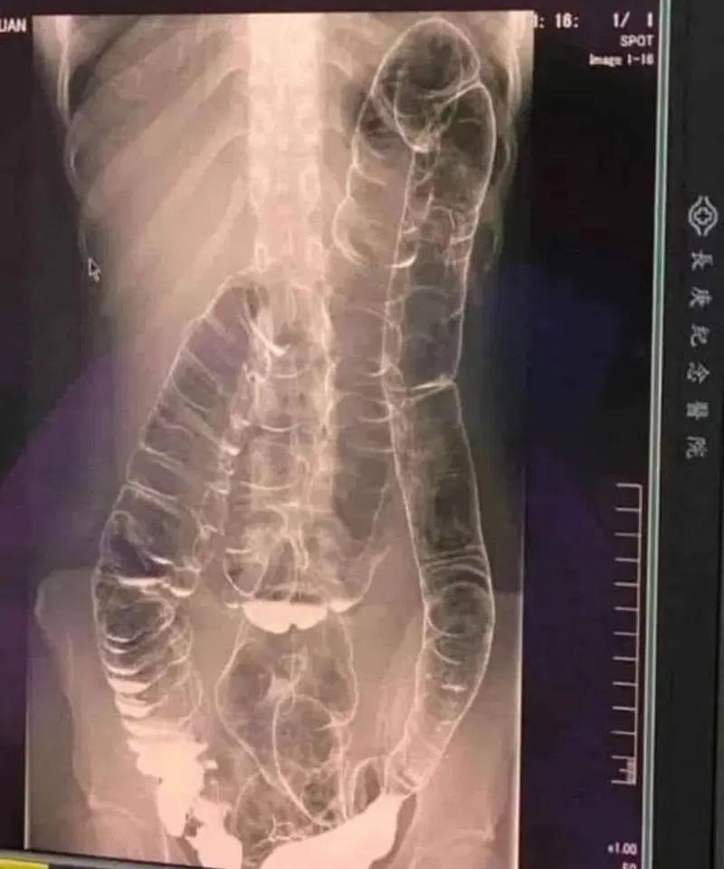 A saturated colon: when the body sounds the alarm