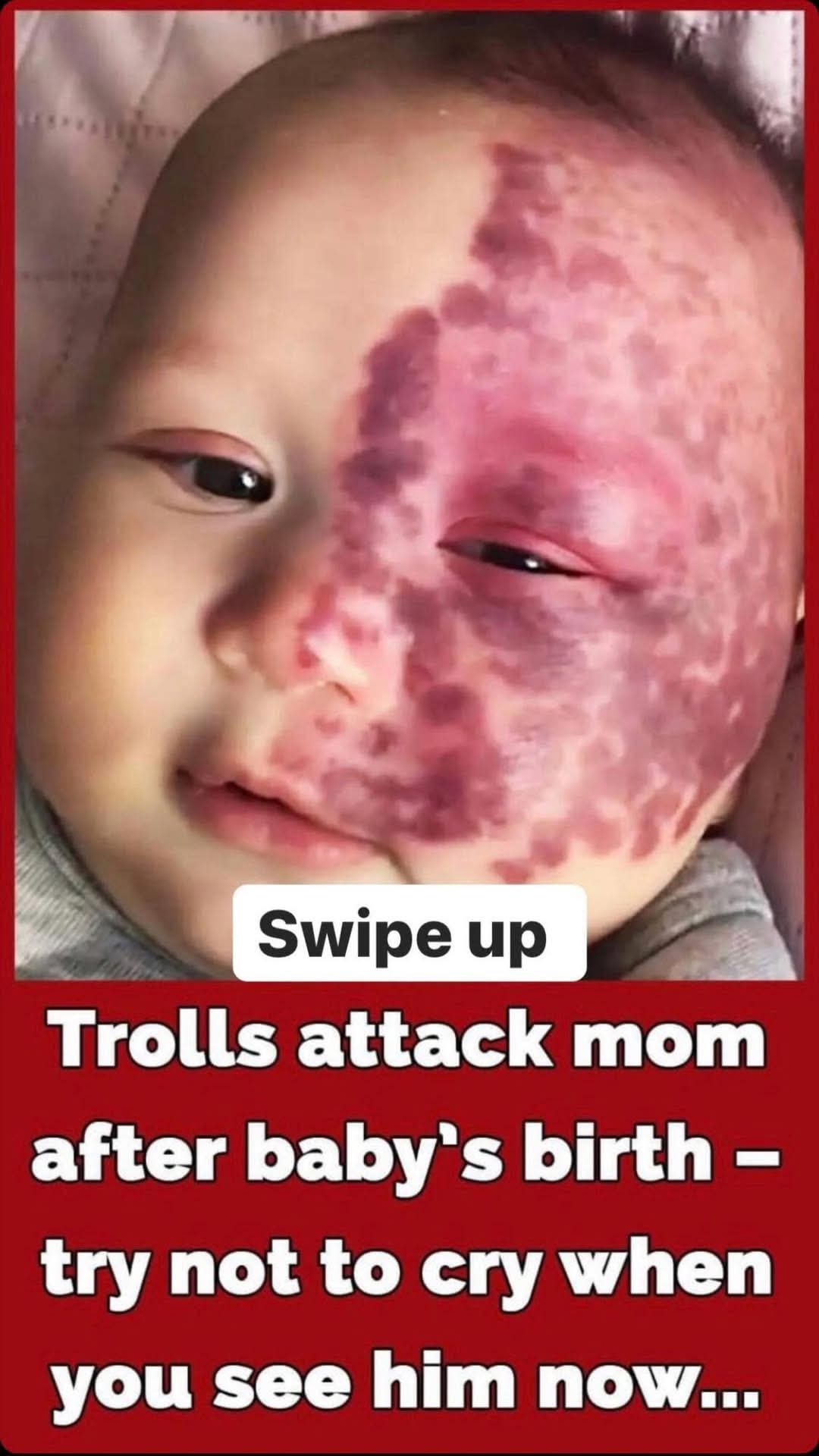 Gold Coast mum labeled a ‘monster’ for lasering her son’s port-wine stain birthmark