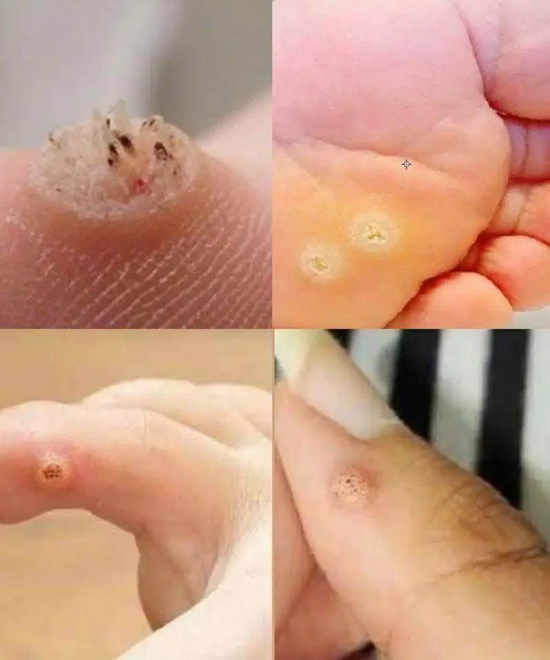 Be Very Careful: If You Notice This Skin Growth, It Could Be Serious