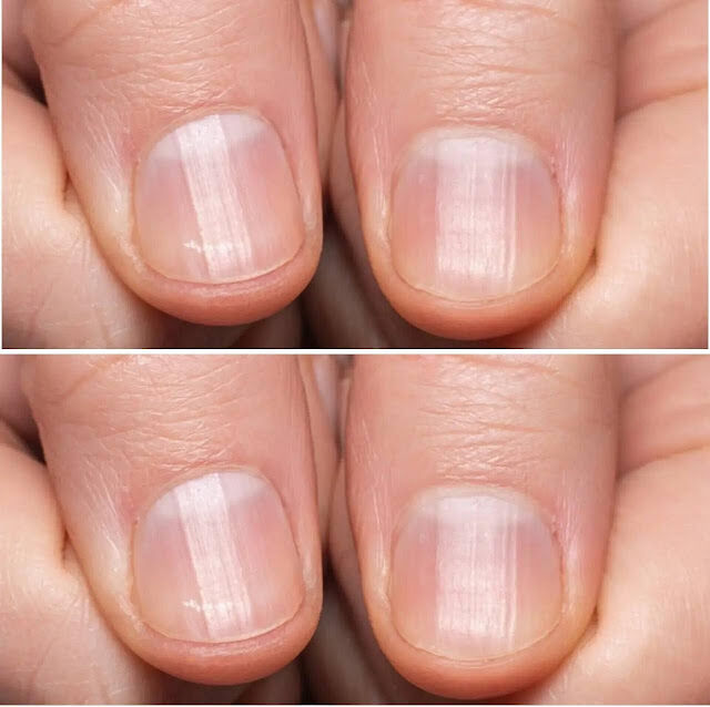 If you have these lines on your nails after 40, it is a clear sign that..