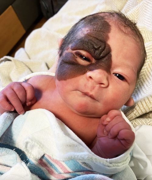 Mom wants daughter with rare birthmark to know she’s beautiful