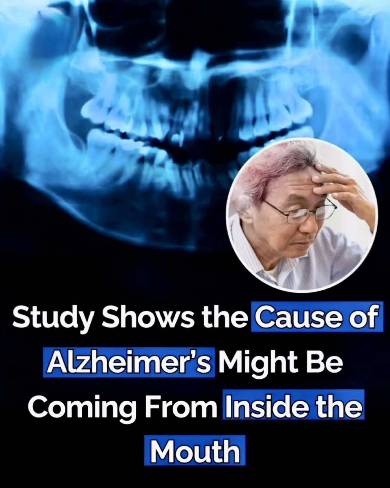 The cause of Alzheimer’s may lie within your mouth